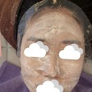 엘로디의원 | 피코프락셀 3회차 후기 내돈내산 (효과, 다운타임, 염증, 부작용 등)