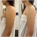 일성메디칼 | 연산동 피부관리 리하에스테틱 팔뚝 관리 테라노바 후기
