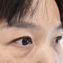 제로원성형외과의원 | 강남 성형외과 하안검 상담받고 수술하고 2달 된 찐 후기