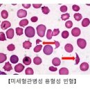 미세혈관병성 용혈성 빈혈 (Microangiopathic hemolytic anemia) 이미지