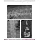 Thoracic vertebral body의 malformation으로 인해 kyphosis와 kyphoscoliosis 이미지