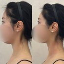 골든핏 프라이빗 짐(275) | 눈수술 붓기 관리 강남 성형붓기림프관리 후기｜수술 당일 성형붓기, 지방흡입 관리 가능한 '다이아...