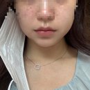 쏘인뷰티 | [수원 인계동 - 세모아의원] 수원 티타늄 리프팅 + 슬림핏 주사 솔직후기 (통증, 7일차 경과, 이벤트 등)