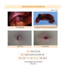 화농성담낭염수술후기. 담석이 7개나 있어 제 기능을 못하였고 담낭 상태가 원체 좋지 않은 것으로 제거를 하였다. 이미지