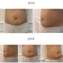 진실어린이집 | 대구리프팅가격 총정리! 써마웨이브(온다리팅), 속지마세요!1만줄 2만4천원..진실