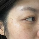윤쓰뷰티 | 내돈내산 기미/잡티 제거 멜라닌샷 추천 합정역 윤쓰아뜰리에