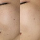 프로로재생의원 | 검단신도시 기미제거 피부관리는 클리어로 미작뷰티김포점에서!