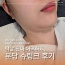 30 | 분당슈링크 후기 30대 턱선 고민으로 알아본 서현리프팅