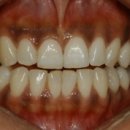 누런치아와 검은잇몸을 어떻게 해야할까요? 치아미백치료와 잇몸미백치료 설명 이미지