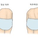 척추측만증(Scoliosis) 이미지