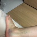 예쓰멍! | 발목부러지고 재활하는 후기 (w 복싱시작)
