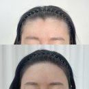 금호라인경로당 | 광주금호동 헤어라인관리, M자이마 채워 인생 바뀐 후기