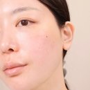 (피부모공케어) 삼성역피부과 추천 포텐자 펌핑팁 &amp; 쥬베룩 스킨부스터 통증부터 가격, 효과까지!