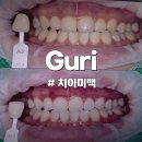 구리 인창동 치과 치아미백 추천! 통증 없이 밝아진 후기