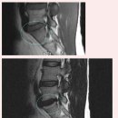 Re:modic change(vertebral endplate signal change) 이미지