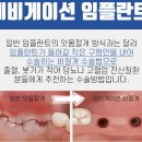 덴토피아치과 네이버블로그