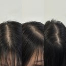 모어댄SMP | 대구 두피 탈모관리는 모어댄SMP 대구본점에서