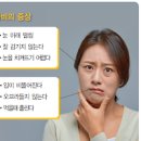 안면마비 원인, 구안와사 전조증상 및 치료 (벨마비, 안면신경마비) 이미지