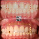 연세대학교의과대학 구내안경원 | 몇 년 전 때운 앞니 레진이 떨어졌어요, 그냥 다시 붙이면 될까요? 의정부 서울랩치과