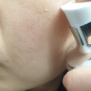 마돈나화장품 | 초등학생 여드름 화장품 홈케어 성공 후기
