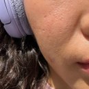 리뉴한의원 | 부산 서면 한의원 여드름 패인흉터치료 새살침 2회차 내돈내산후기