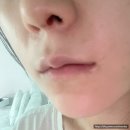 바나나성형외과의원 | 나노의원 코재수술 후 4개월차 feat 분노의 주절주절