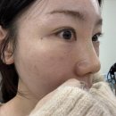 상봉메이퓨어의원 | 상봉역피부과 리투오 친구추천 받아서 다녀온 후기