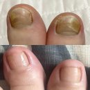 노란 | 발톱연화제 발톱이 울퉁불퉁 노란 발톱무좀 후기