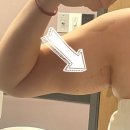 한방의료기 | 미라드라이 청담동피부과 겨드랑이 다한증 제모 땀샘 냄새제거 한번에 끝