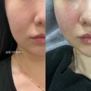 현대자동차블루헨즈해운점 | 압구정로데오 피부과 온다리프팅 4만줄 솔직후기