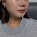 광주보람병원 | 30대 처진 얼굴 고민, 광주 피부과 올타이트리프팅 솔직 후기