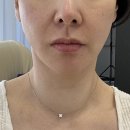 엔데버빌딩 | 강남역 피부과 셀리뉴 레이저 · 코레지 리프팅 효과 후기