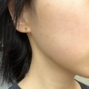 피코토닝효과 ,, (사진은 곧 지울게요) 이미지