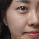 리즈벨의원 | 압구정 가로수길 피부과 MTS GD II 실제 후기~!