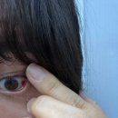 박종철신경정신과의원 | 신도림 삼성드림안과 진료 후기｜눈 실핏줄 터짐, 안압·시신경 검사 결과와 관리법