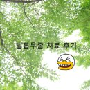 발톱무좀 치료방법, 치료제(외용액), 레이저 치료 후기(내돈내산)