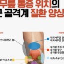 [부산무릎통증] 러닝·등산 후 시큰거리는 무릎, ‘러너스 니(Runner’s Knee)’를 아시나요? (feat. 진심한의원 스포츠 한 이미지