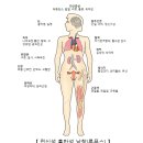 전신 홍반성 낭창Systemic lupus erythematosus 이미지