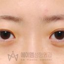 에이엠성형외과의원 네이버블로그