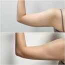 댄의원 | 의정부역 피부과 지방분해 모어컷 [모어댄의원]