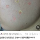 ㅇㅇㅇ 아무도 안 궁금하겠지만 편평 사마귀 100개 조진 후기 (글 김) 이미지