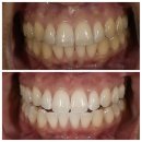 💙 ELITE CARE DENTAL | 9월 한정 미백 이벤트 💙 이미지