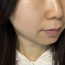 화명역 롯데마트 앞 | 부산 리쥬란 힐러 2cc 만족도 높았던 부산 피부과 후기