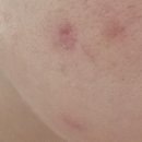 (주)이지모드 | 식스킨 볼케이노샷 + 이지스킵 찐 후기 | 트러블 색소침착 홈케어 루틴