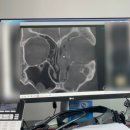 의정부 을지약국 | 부비동염 수술 후기(1) 비염 코 물혹 제거 입원 기간