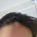 다모드림의원 | [건강정보] 나의 원형탈모 극복기(현재진행중) 2화