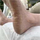 우진메디칼 | 천안 신부동 발각질 깨끗하게 제거 잘하는 오네또 문제성발전문점 각질 무좀 내성발톱