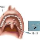 혀 백태 원인 혀 백태 제거 방법 구강칸디다증 구강건조증 이미지