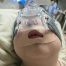 맑은샘이비인후과의원 | 소아 양압기 사용후기, 신촌세브란스병원 이비인후과 어쩌면 마지막 진료(일까?)