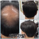 대구가발 실패 없는 선택, 증모가발명장의 노하우
